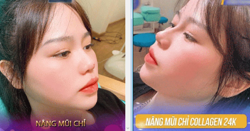 Những hình ảnh được cho rằng Huỳnh Anh chỉnh sửa mũi nhanh chóng được chia sẻ và nhận về nhiều bình luận.