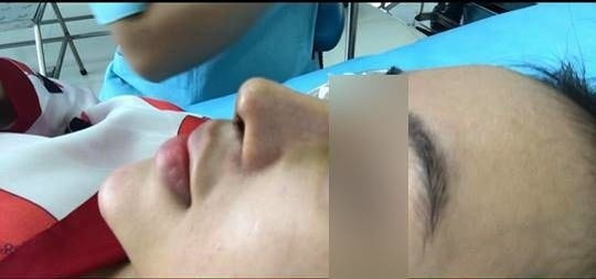 Theo như cô gái chia sẻ trên hội dành cho các tín đồ dao kéo, trước khi làm mũi và gọt cằm, mũi cô nàng khá to và tẹt trông rất thô. Đây chính là điều khiến cô nàng mất tự tin rất nhiều và đi đến quyết định phẫu thuật thẩm mỹ.