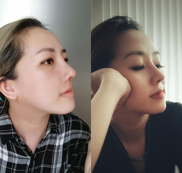 Nhân vật chính với minh chứng nâng mũi thay đổi cuộc sống có tên Cô nàng Tú Anh (33 tuổi) đến từ TP HCM.