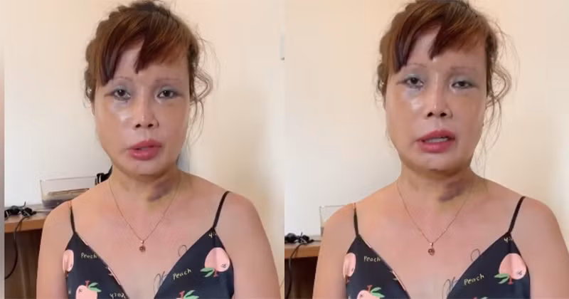 Đáng chú ý sau khi căng da mặt, cô dâu Thu Sao vô tình tiết lộ ý định tiếp tục "tu sửa" vòng một để đẹp hơn.