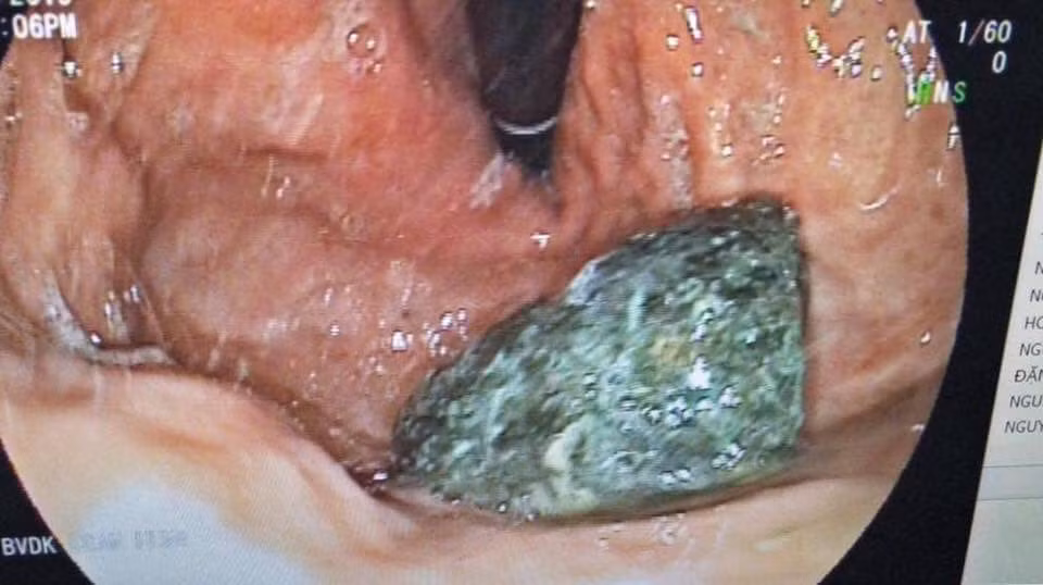 Dan tinh hoang mang vu nhap vien vi tac ruot, nghi do tra sua tran chau-Hinh-2