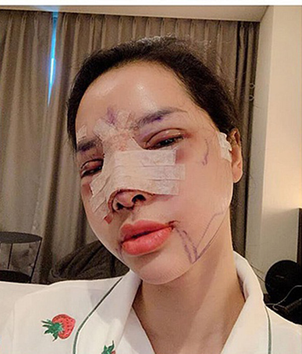 Chị Hạnh, bà mẹ bỉm sữa xin chồng đi phẫu thuật thẩm mỹ cho biết đã nung nấu ý định tân trang nhan sắc cách đây 2 năm sau khi tình cờ đọc được bài viết của một bà chủ Spa tại Hà Thành.