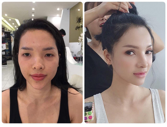 Tại thời điểm đó, chồng chị Hạnh không tin và cũng không muốn vợ đi phẫu thuật vì lo sợ di chứng. Bà mẹ bỉm sữa đã phải thuyết phục chồng rất nhiều, thậm chí dẫn anh tới gặp chị Ngô Thuỳ Linh - người truyền khao khát tân trang nhan sắc cho chị Hạnh, anh mới gật đầu đồng ý.