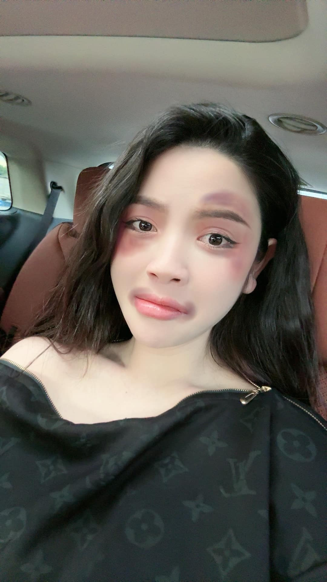 Tuy nhiên, ngay lập tức nhiều người đã nhận ra diện mạo thê thảm như thế này của cả 2 là do một lớp filter mà thành. Bởi trên gương mặt của cặp đôi đều xuất hiện những vết thâm tím cùng chỗ và y chang như nhau.