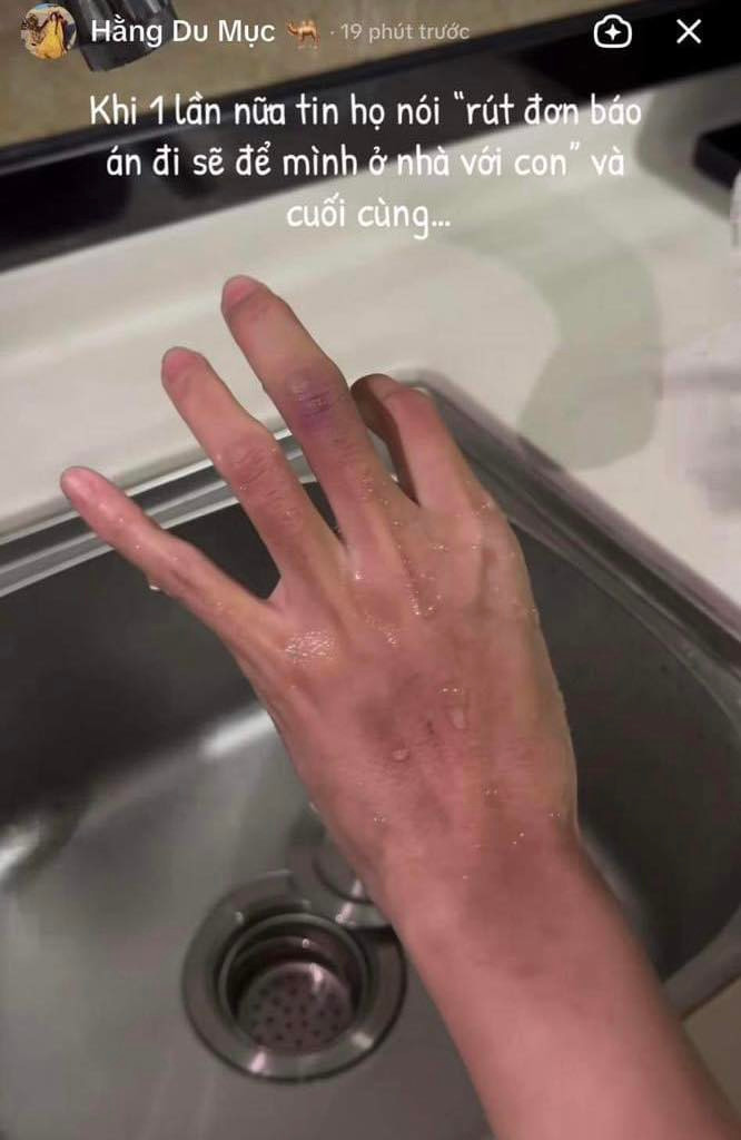 Giữa tin đồn cô và chồng bất đồng quan điểm, nhiều người nghi ngờ cô nàng đã bị chồng "tăng tương tác". Sau đó, chồng của cô đã lên tiếng cho rằng Hằng cố tình bôi phấn vào chứ không phải là vết bầm. Rạng sáng 21/6, Hằng Du Mục đăng story với nội dung đang rửa tay dưới vòi nước chảy ngầm khẳng định đây không phải là vết tích do trang điểm.