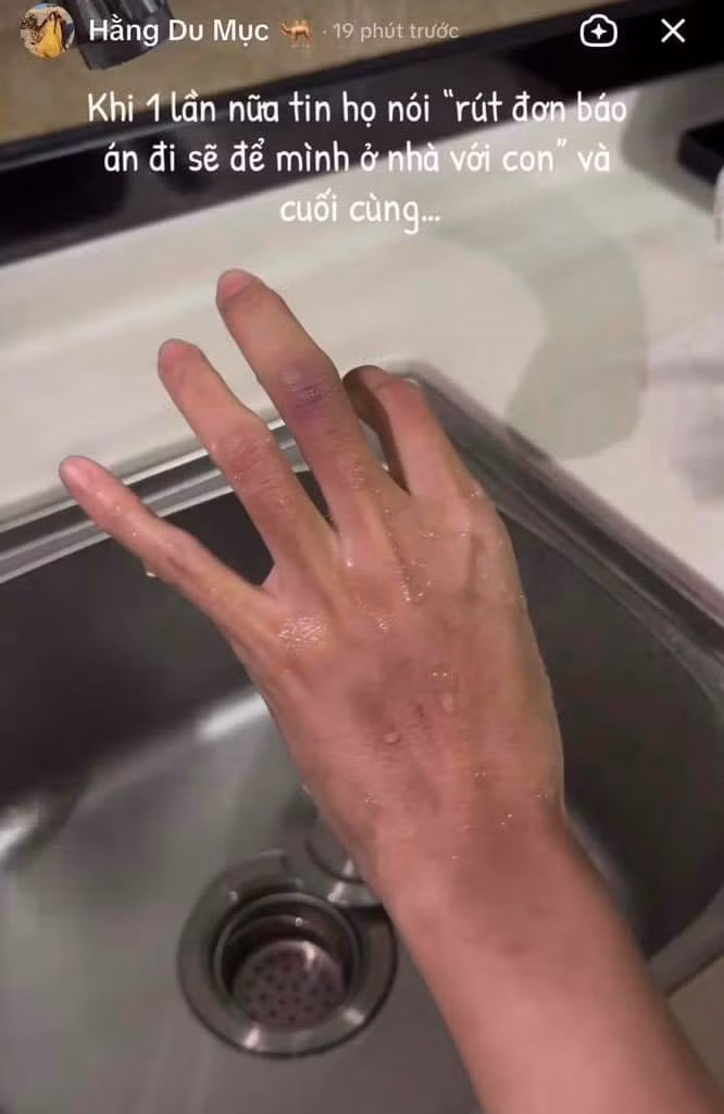 Giữa tin đồn cô và chồng bất đồng quan điểm, nhiều người nghi ngờ cô nàng đã bị chồng "tăng tương tác". Sau đó, chồng của cô đã lên tiếng cho rằng Hằng cố tình bôi phấn vào chứ không phải là vết bầm. Rạng sáng 21/6, Hằng Du Mục đăng story với nội dung đang rửa tay dưới vòi nước chảy ngầm khẳng định đây không phải là vết tích do trang điểm.