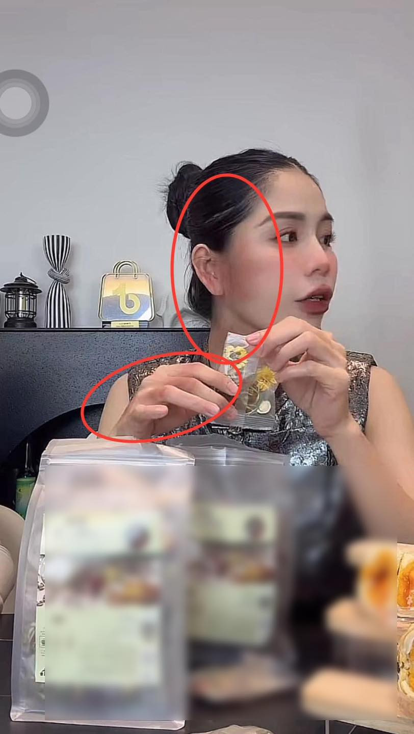 Tối 20/6, MXH dậy sóng khi hình ảnh Hằng Du Mục xuất hiện trong phiên live với vết bầm tím trên phần mặt cũng như bàn tay.