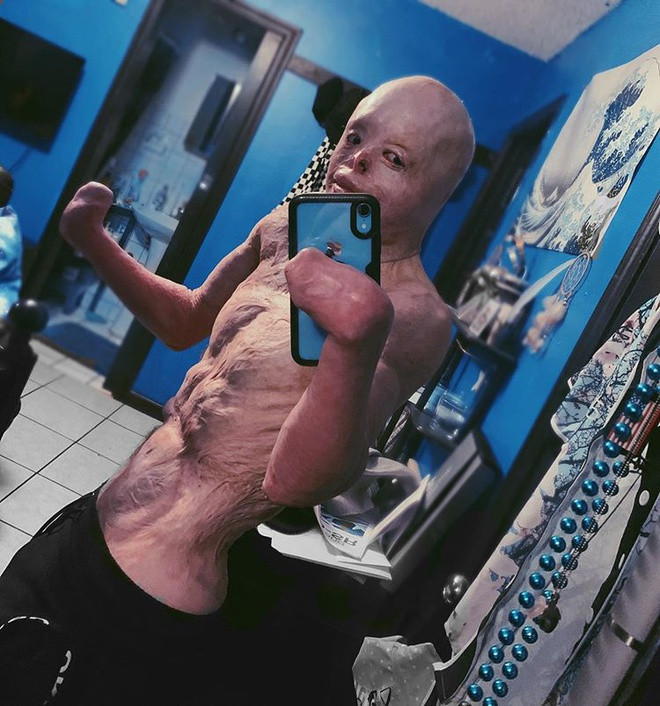 Johnny không coi mình là nạn nhân bỏng, mà tự gọi mình là “người chiến thắng”. Hiện chàng trai 20 tuổi theo đuổi nghề người mẫu. 9X tích cực tập luyện để có cơ thể khỏe mạnh với cơ bụng 6 múi.