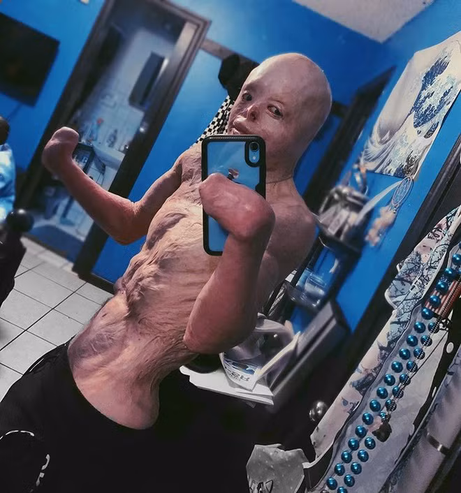 Johnny không coi mình là nạn nhân bỏng, mà tự gọi mình là “người chiến thắng”. Hiện chàng trai 20 tuổi theo đuổi nghề người mẫu. 9X tích cực tập luyện để có cơ thể khỏe mạnh với cơ bụng 6 múi.