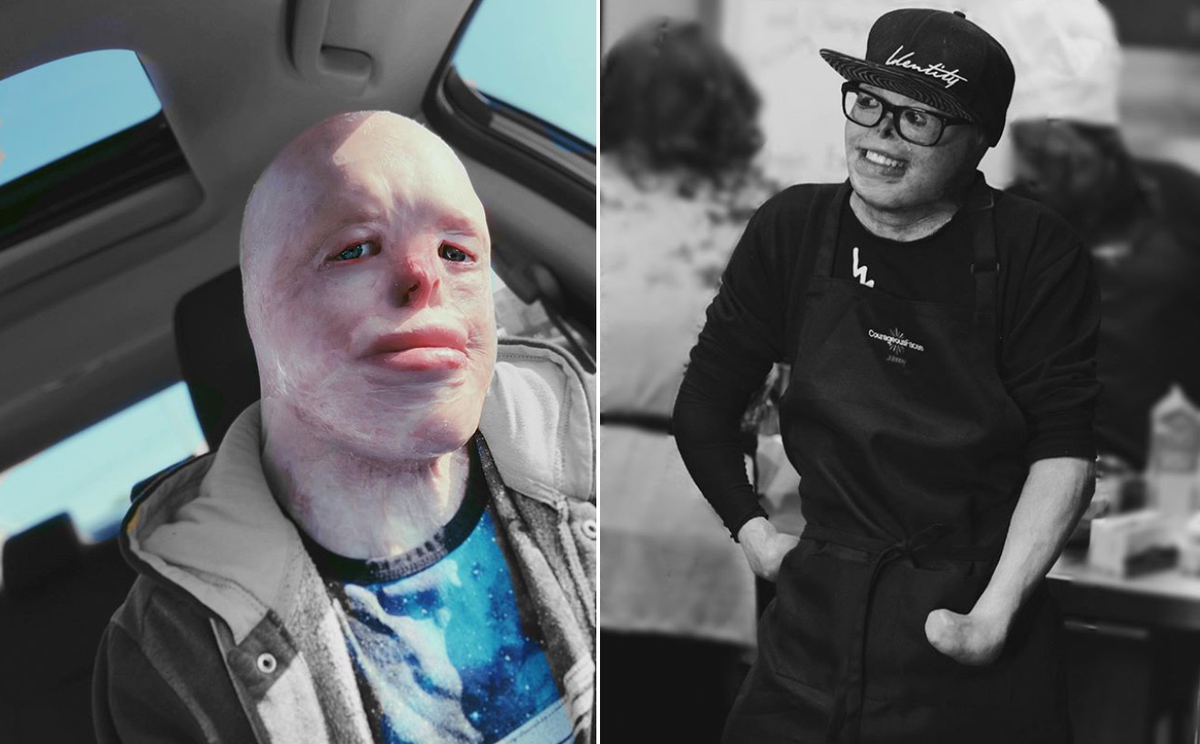 Mọi chuyện cứ thế trôi đi, cho đến khi Johnny khoảng 10-11 tuổi. Cậu bắt đầu để ý đến ngoại hình và nhận thấy mình trông không giống mọi người. “Tôi chán ghét cơ thể của mình vì mỗi khi ra ngoài đường, ai cũng nhìn chằm chằm vào tôi. Điều đó khiến tôi cảm thấy nặng nề hơn cả cảm giác đau đớn từ những vết bỏng”, Johnny từng nói với Barcroft TV.