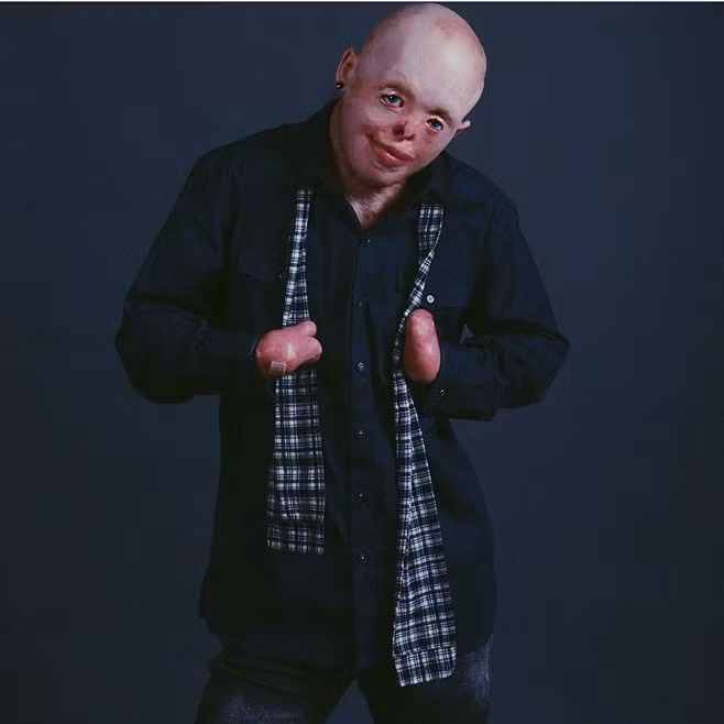 “Mãi sau tôi mới nhận ra mình ích kỷ đến thế nào. Rõ ràng là tôi có một gia đình yêu thương, quan tâm đến mình nhưng lại lờ đi điều đó”, Johnny nói. Cuối cùng, chàng trai nhận ra anh phải học cách yêu lấy bản thân trước khi sự thiếu tự tin hủy hoại con người mình.