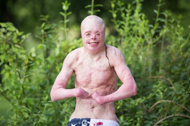 Sau trận hỏa hoạn, dù giữ được mạng sống, Johnny bị bỏng tới 95% cơ thể. Gương mặt chàng trai hoàn toàn biến dạng, đôi bàn tay cụt hết và làn da trên cơ thể đều co rút, sần sùi. Cậu phải trải qua hơn 80 cậu phẫu thuật để khắc phục di chứng bỏng. Đến giờ, nhớ lại ngày hôm đó, Leah vẫn còn nhớ như in cảm giác hoảng loạn, kinh hoàng khi thấy em trai quằn quại trên đất vì đau đớn.