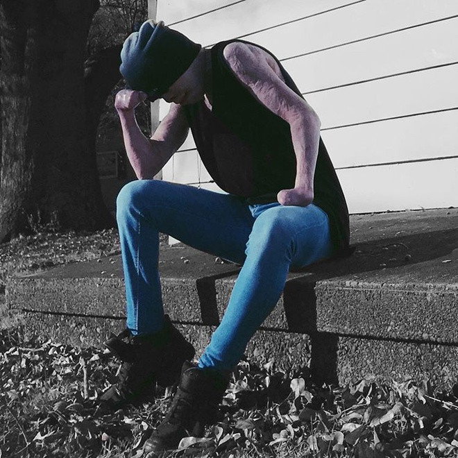 Hàng nghìn lần Johnny tự dằn vặt mình bằng những câu hỏi tiêu cực: “Tại sao tôi còn sống sót?”, “Sao tôi không chết quách đi trong đám lửa kia cho rồi?”. Chàng trai cảm thấy mình như quái vật và không dám mơ tới việc có bạn bè chơi cùng. Nỗi đau đớn tích tụ dần khiến Johnny bỏ mặc cơ thể và mắc chứng biếng ăn.