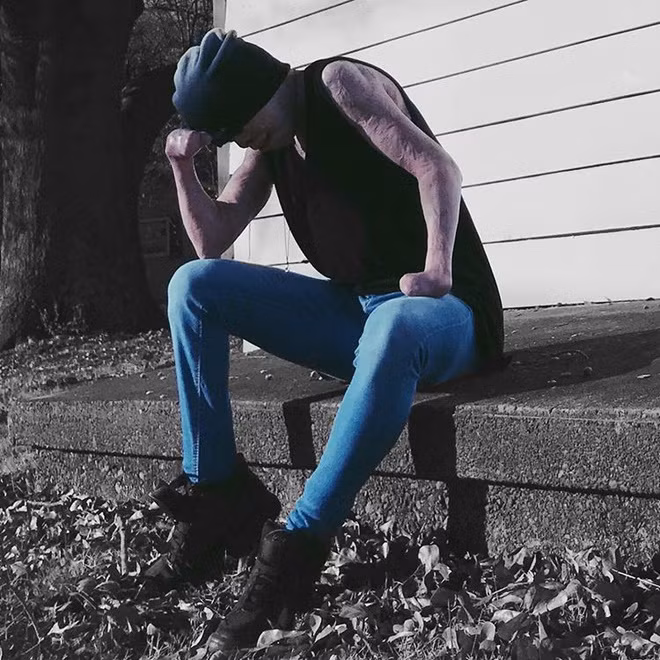 Hàng nghìn lần Johnny tự dằn vặt mình bằng những câu hỏi tiêu cực: “Tại sao tôi còn sống sót?”, “Sao tôi không chết quách đi trong đám lửa kia cho rồi?”. Chàng trai cảm thấy mình như quái vật và không dám mơ tới việc có bạn bè chơi cùng. Nỗi đau đớn tích tụ dần khiến Johnny bỏ mặc cơ thể và mắc chứng biếng ăn.