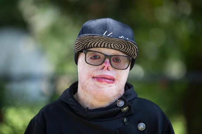 Bỏng 95% cơ thể, chàng trai từng coi mình là quái vật giờ ra sao? Bong 95% co the, chang trai tung coi minh la quai vat gio ra sao?