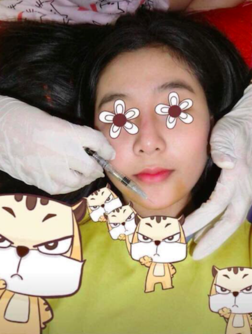 Thời gian trước, CĐM xôn xao với bức ảnh một cô gái được cho là giống Ngọc Trân đang tiến hành tiêm filler cằm.