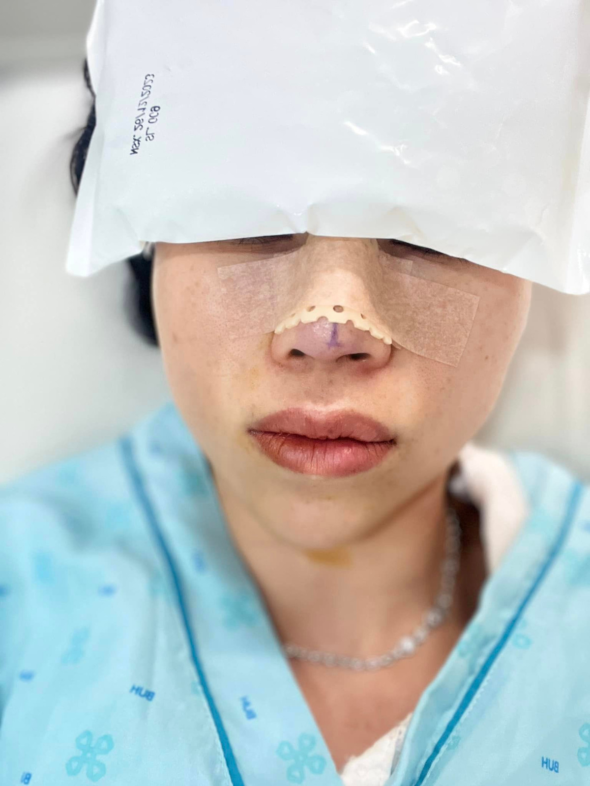 Sau 1 thời gian tuyên bố giải nghệ từ những lùm xùm. Thơ Nguyễn cách đây không lâu xuất hiện lại với hình ảnh đang trải qua những cuộc phẫu thuật thẩm mỹ gần như toàn bộ gương mặt.