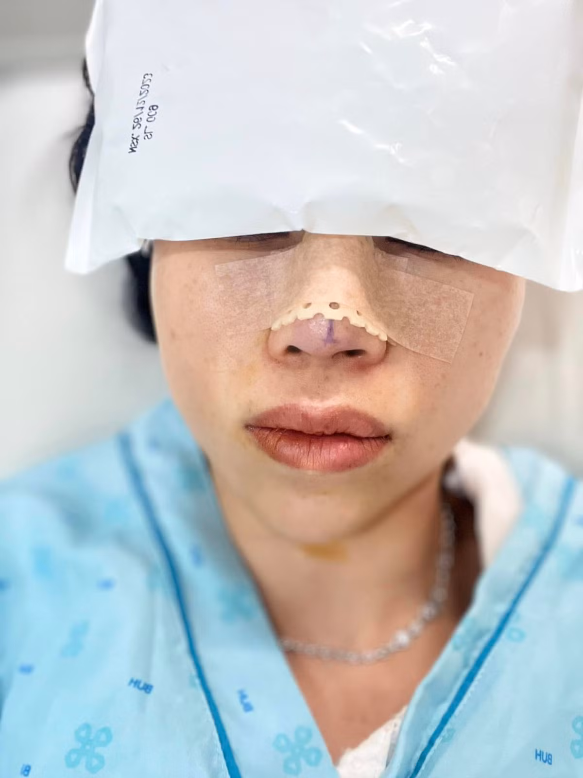 Sau 1 thời gian tuyên bố giải nghệ từ những lùm xùm. Thơ Nguyễn cách đây không lâu xuất hiện lại với hình ảnh đang trải qua những cuộc phẫu thuật thẩm mỹ gần như toàn bộ gương mặt.