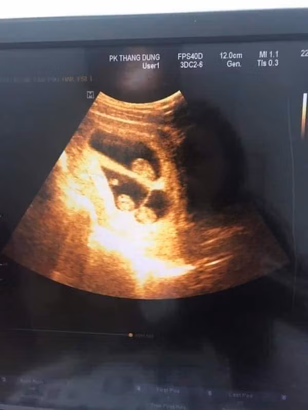 Người xưa vẫn có câu: "Hai vợ chồng son thêm đứa con thành bốn" để miêu tả sự thay đổi rất lớn của một cặp vợ chồng khi có con nhỏ. Thế nhưng cặp vợ chồng này không chỉ có 1 em bé, mà một lần đón những 3 thiên thần chào đời cùng lúc.