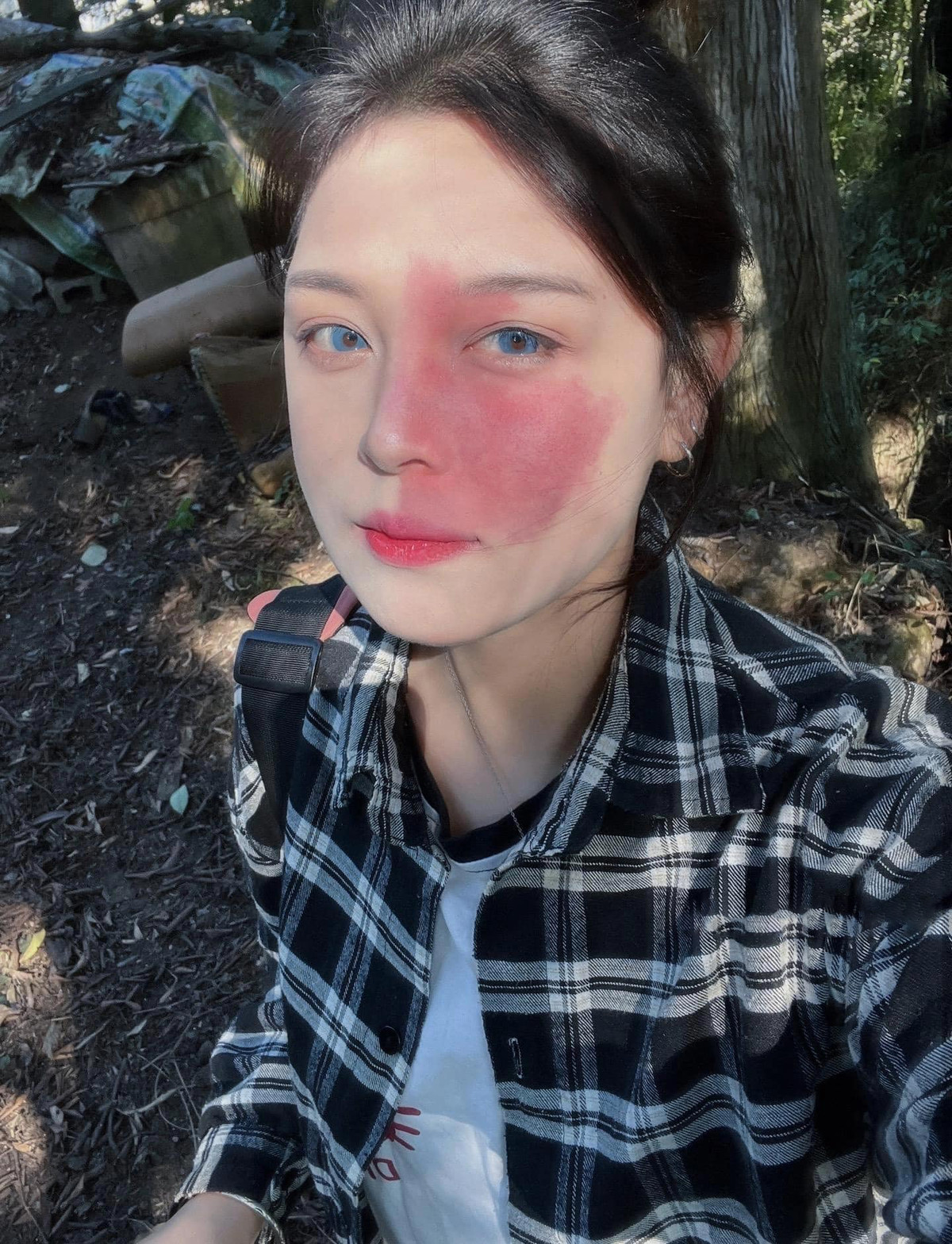 Mới đây, hình ảnh về một cô gái có vết bớt đỏ chiếm gần nửa trái khuôn mặt được đăng tải đã khiến nhiều người xôn xao. Vết bớt có màu đỏ, bắt đầu từ má qua đến nữa cánh mũi.