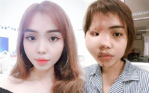 Cách đây 1 năm, vụ việc cô gái tên Lan Vy bị chính chồng mình tạt thẳng axit vào mặt vì ghen tuông vô lối khiến cộng đồng mạng bức xúc.