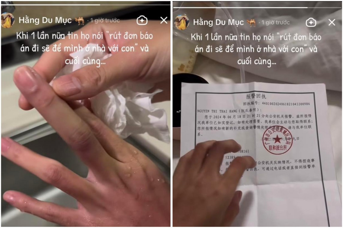 Rạng sáng ngày 21/6 Hằng Du Mục bất ngờ đăng story lên TikTok của mình với nội dung hình ảnh rửa tay khẳng định vết bầm là do bị “tác động vật lý” chứ không phải phấn trang điểm.