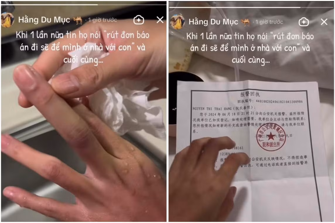 Rạng sáng ngày 21/6 Hằng Du Mục bất ngờ đăng story lên TikTok của mình với nội dung hình ảnh rửa tay khẳng định vết bầm là do bị “tác động vật lý” chứ không phải phấn trang điểm.