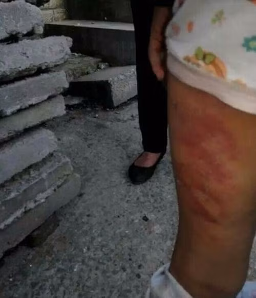 Một người hàng xóm họ Hoàng chia sẻ: "Chúng tôi thấy Đồng Đồng bị thương nặng, máu chảy ròng ròng đã chuẩn bị đưa cô bé tới bệnh viện, tuy nhiên Đồng Đồng không đứng lên được vì bị đau, chúng tôi cởi quần cô bé ra thì thấy toàn thân thương tích, vết thương mới chồng lên vết thương cũ thực sự rất đáng sợ".