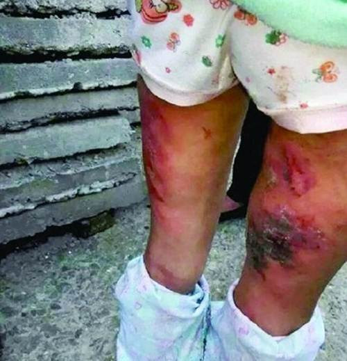 Cảnh sát đã vào cuộc điều tra khi hàng xóm và bạn học của Đồng Đồng khẳng định cô bé thường xuyên bị đánh đập. Qua hình ảnh có thể thấy, cô bé bị đánh đến nỗi toàn thân, đặc biệt là chân và tay chảy máu, bầm tím nghiêm trọng trên diện rộng.