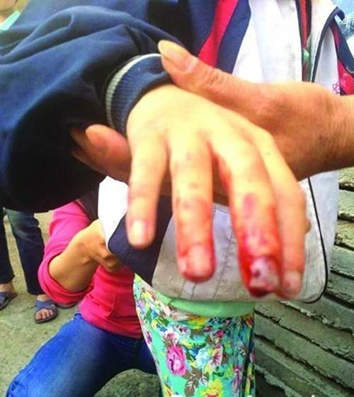 Những hình ảnh Đồng Đồng, một cô nhóc 7 tuổi, đang học lớp 2 bị cha ruột và mẹ kế bạo hành dã man đang khiến cho cộng đồng mạng Trung Quốc hết sức phẫn nộ.