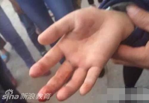 Cư dân mạng Trung Quốc cực kỳ phẫn nộ với hành vi bạo hành trẻ em của cha ruột và mẹ kế Đồng Đồng. Họ lên tiếng yêu cầu giới chức địa phương có trách nhiệm hơn, đưa cô bé vào trung tâm hỗ trợ trẻ em và trừng phạt những người làm cha mẹ không có lương tâm kia.