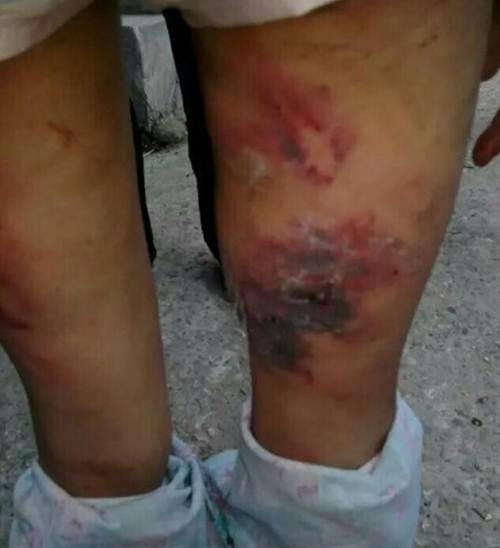 Ngày mà Đồng Đồng được một người hàng xóm chụp ảnh, cô bé bị đánh đến biến dạng cả ngón tay, máu chảy ròng ròng. Sau khi chạy trốn khỏi cha và mẹ kế, cô bé ngồi bệt xuống vì đau. Người dân quanh đấy thấy thế, quá bức xúc đã chụp ảnh lại và đăng tải trên mạng. Rất nhanh câu chuyện và những hình ảnh của Đồng Đồng được lan tỏa trên mạng.