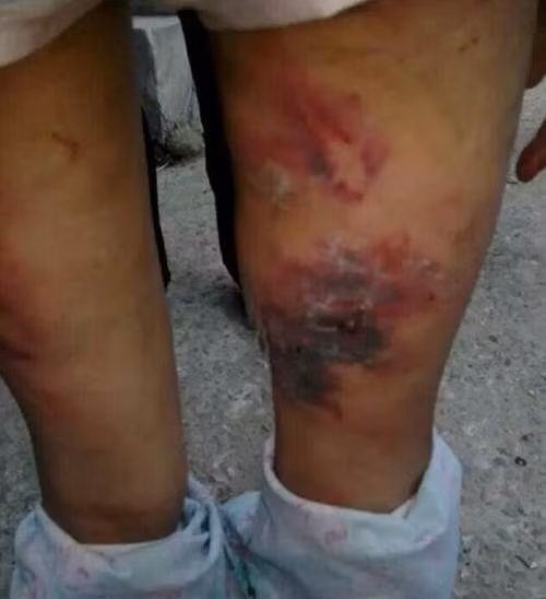 Ngày mà Đồng Đồng được một người hàng xóm chụp ảnh, cô bé bị đánh đến biến dạng cả ngón tay, máu chảy ròng ròng. Sau khi chạy trốn khỏi cha và mẹ kế, cô bé ngồi bệt xuống vì đau. Người dân quanh đấy thấy thế, quá bức xúc đã chụp ảnh lại và đăng tải trên mạng. Rất nhanh câu chuyện và những hình ảnh của Đồng Đồng được lan tỏa trên mạng.