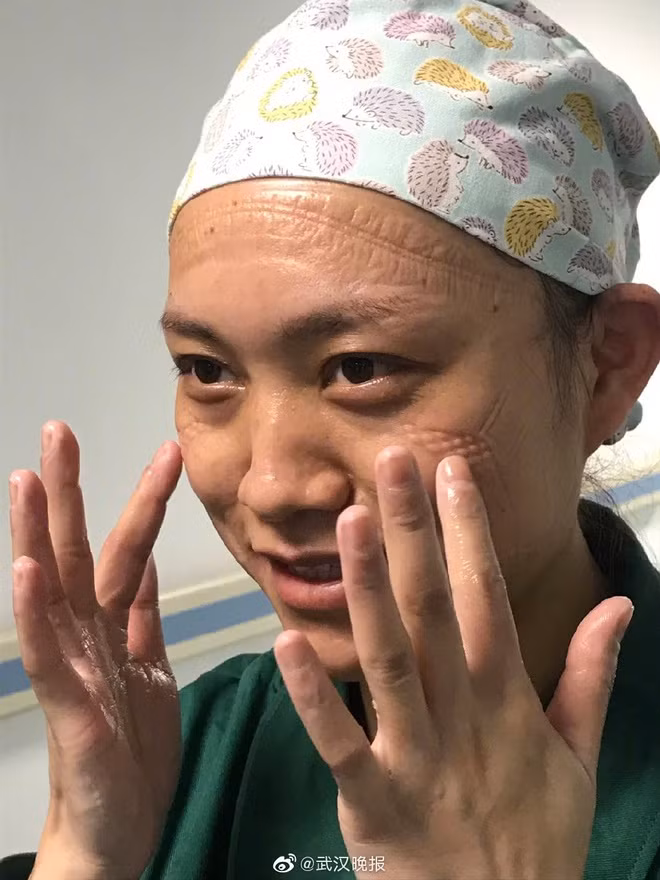 Thậm chí, nhiều dân mạng còn dân chứng do đeo khẩu trang bảo hộ trong một thời gian dài nên trên gương mặt tất cả nhân viên y tế đều xuất hiện vệt hằn chằng chịt. Điều này cho thấy công việc đánh đuổi virus Corona của các bác sĩ tại Vũ Hán căng thẳng đến thế nào. Nguồn ảnh: Weibo.