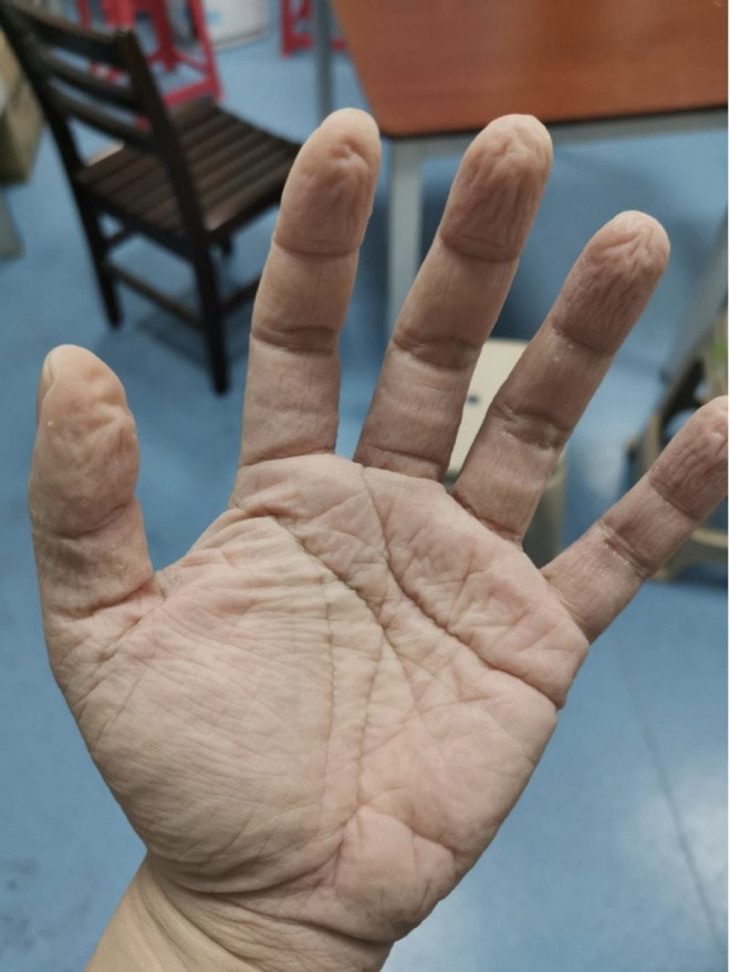 Đeo găng tay trong nhiều giờ liền khiến tay nhăn nheo do bị chảy mồ hôi vô cùng khó chịu. Xem thêm clip: Dịch Corona: Hơn 40 người chết/ngày, Việt Nam 7 người nhiễm bệnh | VTC16 - Nguồn: Youtube