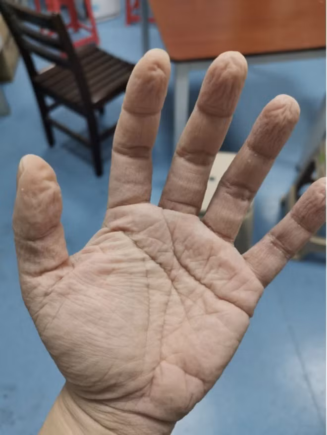 Đeo găng tay trong nhiều giờ liền khiến tay nhăn nheo do bị chảy mồ hôi vô cùng khó chịu. Xem thêm clip: Dịch Corona: Hơn 40 người chết/ngày, Việt Nam 7 người nhiễm bệnh | VTC16 - Nguồn: Youtube