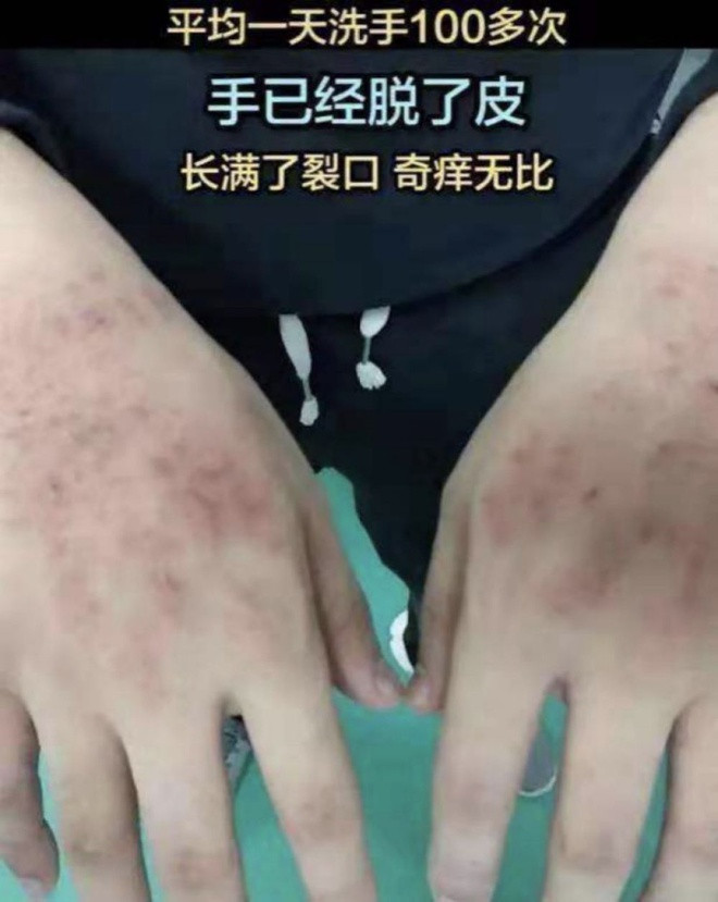 Đôi tay do chà rửa với hóa chất, dung dịch vệ sinh mà trầy xước, sưng to của các bác sĩ tại Vũ Hán khiến không ít dân mạng bày tỏ sự thương cảm.
