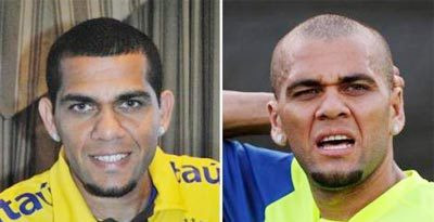 Người hâm mộ dự đoán rằng Dani Alves đã tới phòng phẫu thuật thẩm mỹ trong những ngày cuối cùng của giải Confederations Cup hồi tháng 6/2009 để chỉnh lại đôi tai.