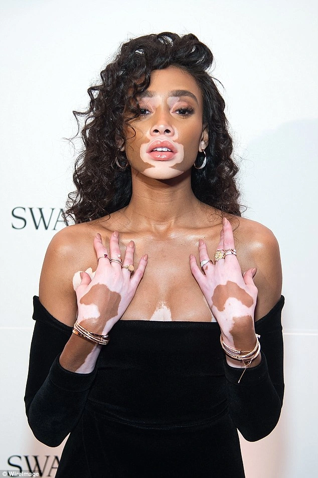 Winnie Harlow là 1 gương mặt nổi tiếng trong làng mẫu thế giới nhờ làn da bạch biến. Cô là một trong những nàng mẫu đắt show nhất hiện tại
