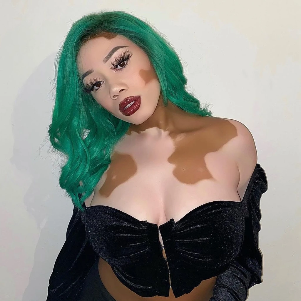 "Trong nhiều năm, tôi mặc quần dài và sơ mi vào giữa mùa hè. Khi đến hồ bơi với gia đình, tôi luôn kiếm cớ để không phải đi cùng". Đến năm 15 tuổi, cô dần suy nghĩ tích cực hơn và không muốn che giấu bản thân thêm nữa. 9X cho rằng những mảng da khác biệt này là điểm nhấn hoàn hảo.