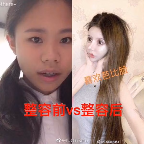 Tại Trung Quốc, việc phẫu thuật thẩm mỹ từ khi còn nhỏ không hề xa lạ. Nana, cô gái có khuôn mặt rắn cũng bắt đầu dao kéo từ năm 13 tuổi.