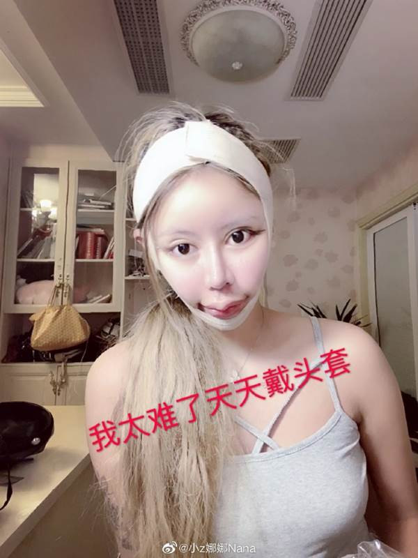 Nana cho biết, khi còn bé, cô nàng luôn bị bạn bè mang ra trêu đùa vì ngoại hình xấu xí. Đoi mắt híp, sống mũi thấp và hàm răng hô khiến cô tự ti không dám ra đường. Phải chịu quá nhiều lời cay nghiệt từ những người xung quanh nên cô nàng quyết tâm phẫu thuật thẩm mỹ từ năm 13 tuổi.