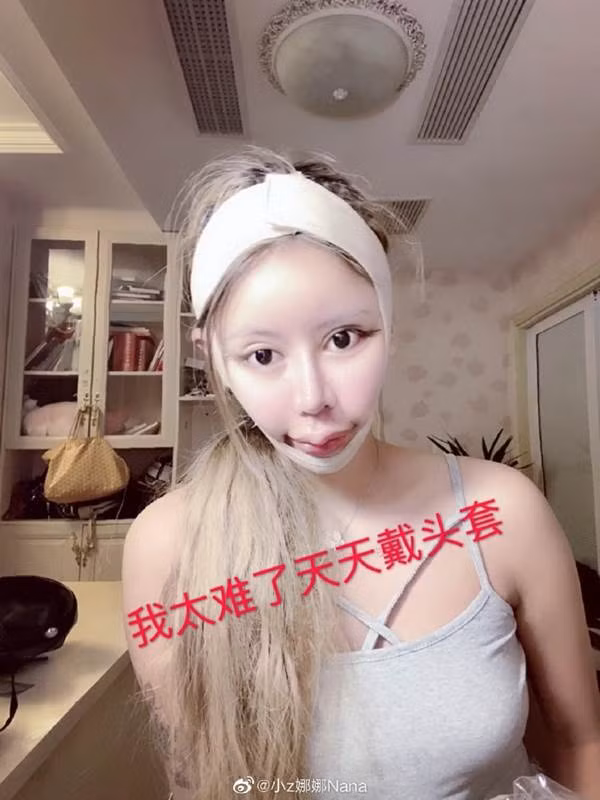 Nana cho biết, khi còn bé, cô nàng luôn bị bạn bè mang ra trêu đùa vì ngoại hình xấu xí. Đoi mắt híp, sống mũi thấp và hàm răng hô khiến cô tự ti không dám ra đường. Phải chịu quá nhiều lời cay nghiệt từ những người xung quanh nên cô nàng quyết tâm phẫu thuật thẩm mỹ từ năm 13 tuổi.