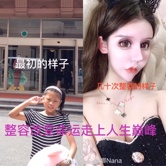 Mới đây, dân mạng Trung Quốc xôn xao trước hình ảnh khuôn mặt biến dạng do phẫu thuật thẩm mỹ của một cô gái có tên Nana (16 tuổi). Cô gái này đã từng nổi tiếng vào thời điểm cách đây 3 năm cũng với lý do này nhưng ngày càng, khuôn mặt của cô càng trở nên đáng sợ hơn.
