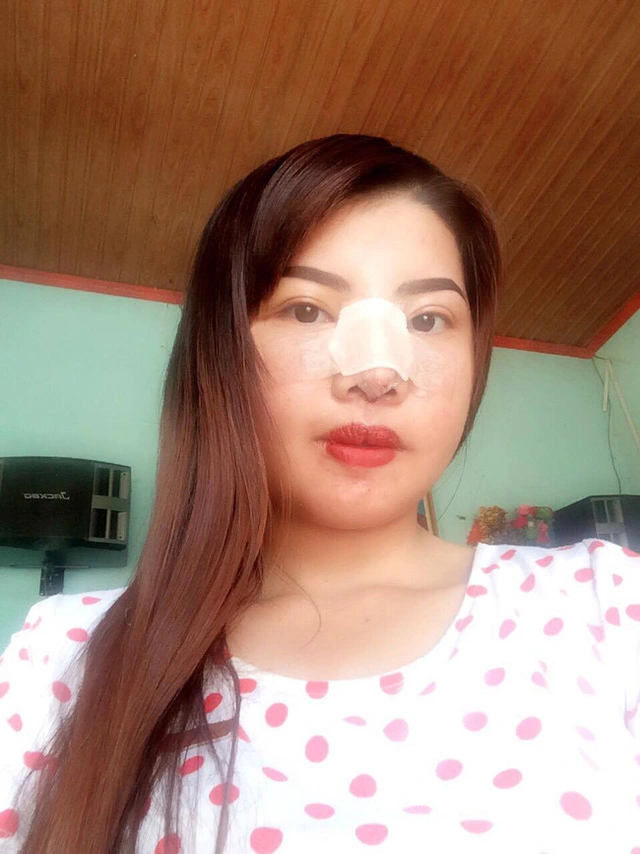 Tiếp theo là nâng mũi.