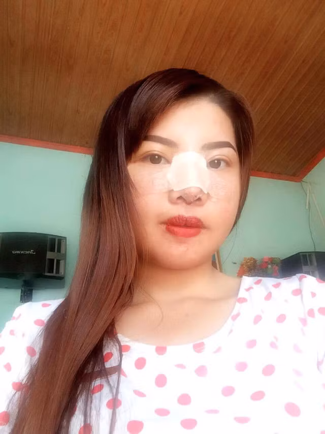 Tiếp theo là nâng mũi.