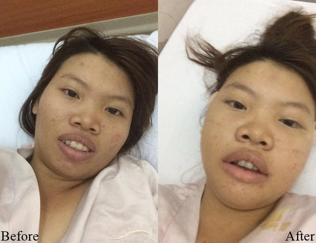 Có thể thấy ban đầu cô nàng sở hữu gương mặt thô kệch, răng hô, da đen đúa, chi chít mụn. Ước mơ thoát khỏi sự mặc cảm, tự ti vì ngoại hình kém sắc, cô quyết định "đập mặt xây lại", bắt đầu với cuộc phẫu thuật hạ gò má.