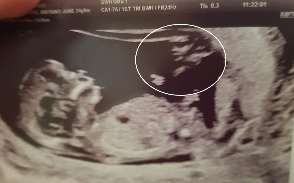 Me tre thay bong la trong anh sieu am thai, bat ngo ky dieu...