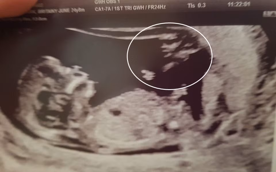 Me tre thay bong la trong anh sieu am thai, bat ngo ky dieu...