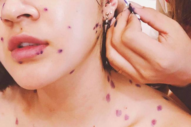 Hình ảnh Bảo Anh bị thủy đậu sau khi kiệt sức vì lịch làm việc quá dày đặc được quản lý của cô chia sẻ.